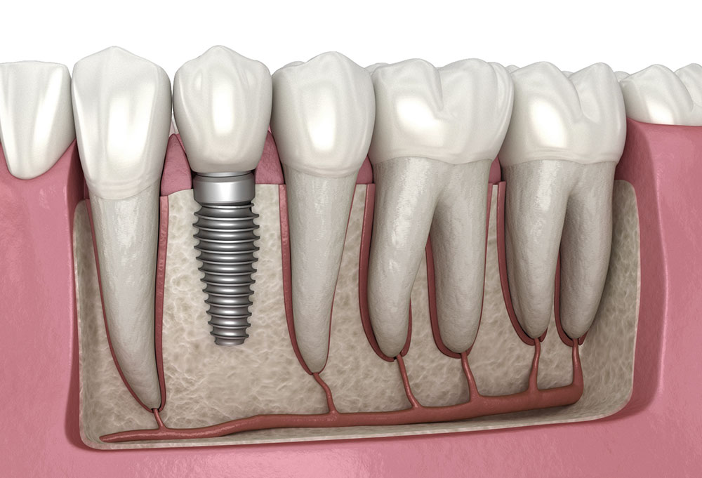Cross-sectional illustration of a dental implant supporting a replacement tooth in the jawbone.